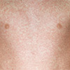 Measles-Outbreak-Recognition-and-Management