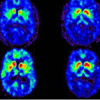 Parkinsons-Disease